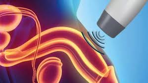 Shockwave therapy for erectile dysfunction treatment in Frederick MD